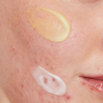 Skin Purging