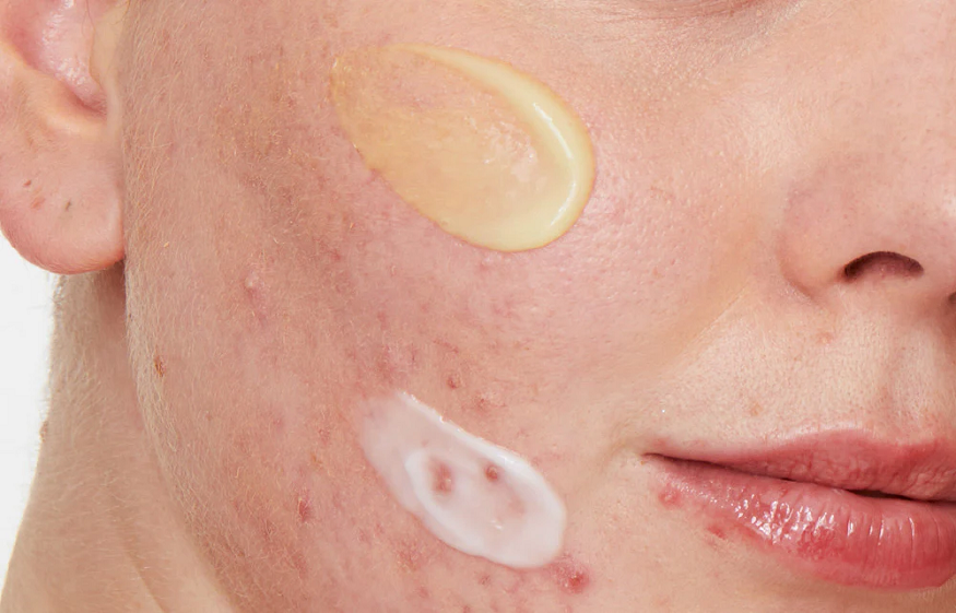 Skin Purging